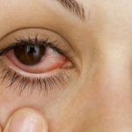 Причины развития воспалительного заболевания глаз