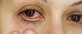 Causes of development of inflammatory eye disease
