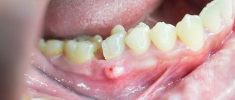 inflammation of the periosteum of the tooth